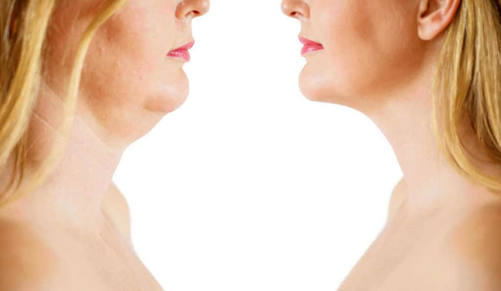 Double Chin treatment Streatham Hill before and after results