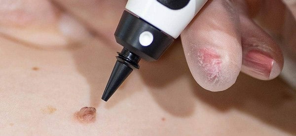 After Skin Tag Removal Streatham Hill