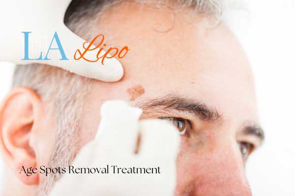 What Are the Most Effective Treatments for Age Spots Streatham Hill?