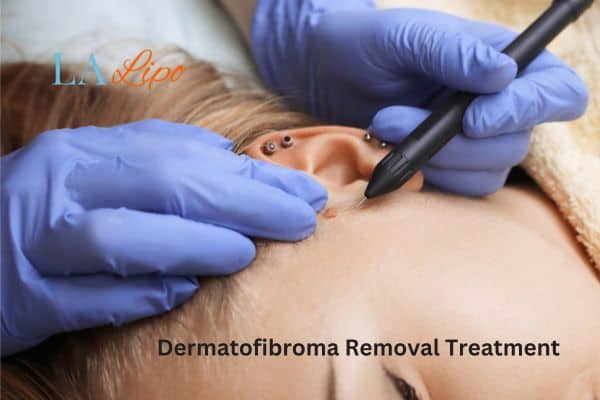 Dermatofibroma Removal Treatment Streatham Hill