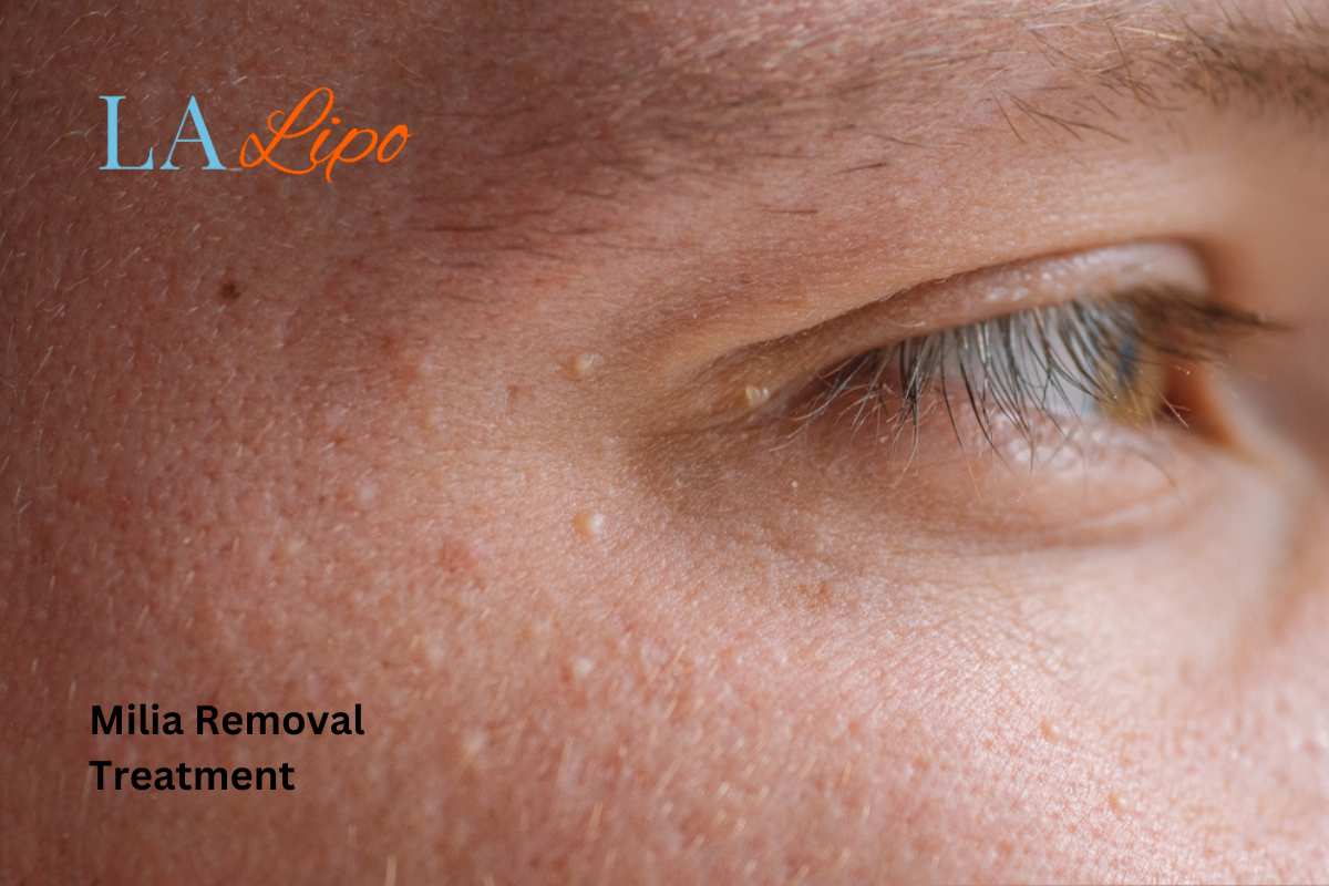 Cryopen Milia Removal: Is It the Easiest and Safest Option Streatham Hill?