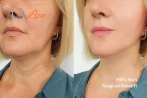 hi-fu for wrinkles Streatham Hill before and after results