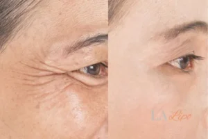 Before and after results of woman - HI-fu wrinkles reduction treatment Streatham Hill