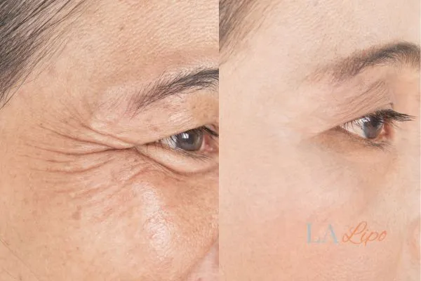 Before and after results of woman - HI-fu wrinkles reduction treatment Streatham Hill