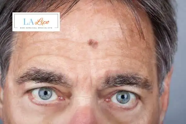 Solar Lentigo Removal Streatham Hill image of man with mark on his forehead