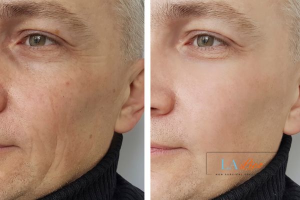 See the amazing results of Morpheus8 Treatment Streatham Hill!