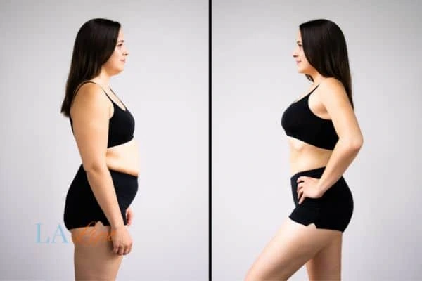Picture of womans before and after using LA-EMS body sculpting to improve her core strength Streatham Hill