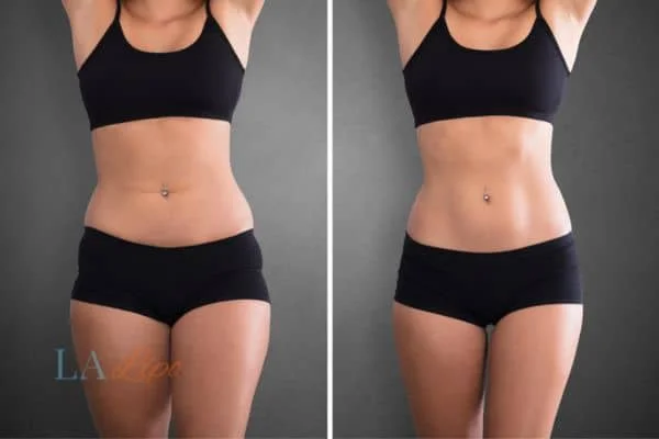 before and after results of non-surgical treatment to help a woman's body image and mental health Streatham Hill
