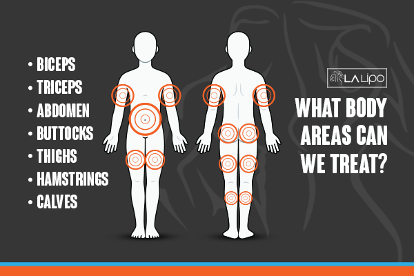 Diagram to show areas you can have LA-EMS Body Sculpting Treatment Streatham Hill