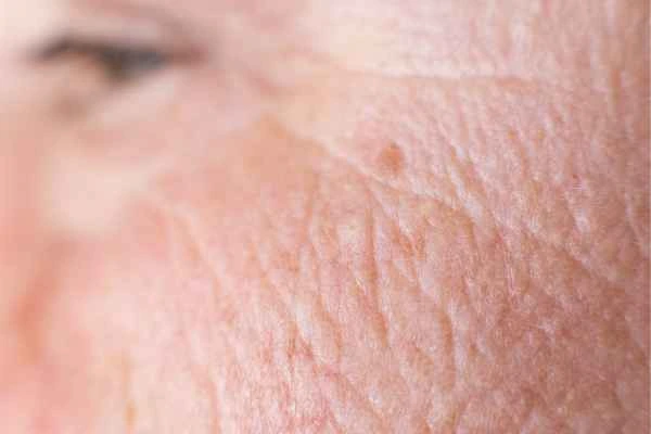 close up picture of a woman's face showing an age spot Streatham Hill