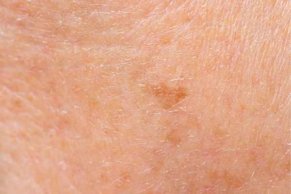close up picture of age spots Streatham Hill
