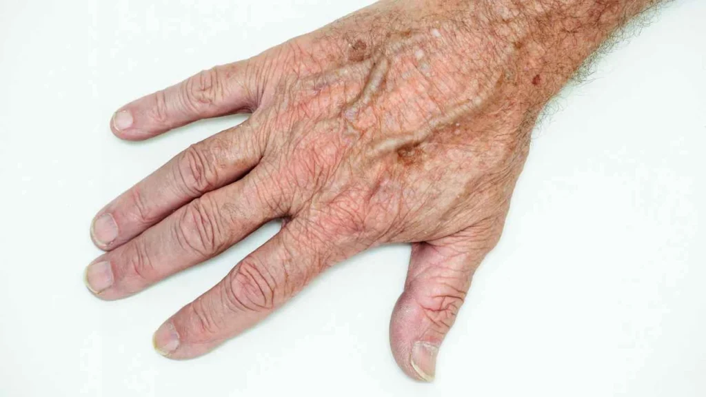 Male hand showing age spot Streatham Hill