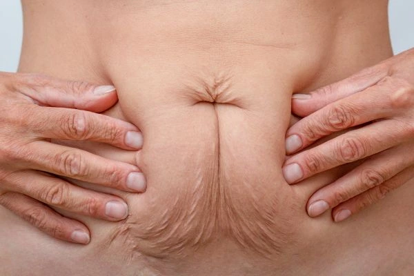 Should I Combine Diastasis Recti Treatment with Body Contouring for Better Results Streatham Hill?